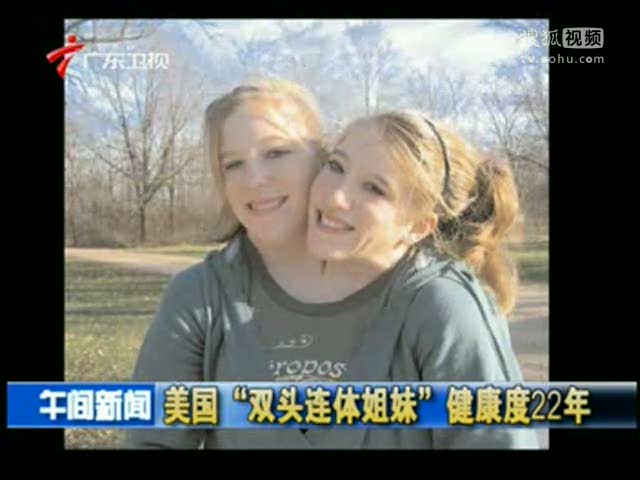 美国“双头连体姐妹”健康度22年